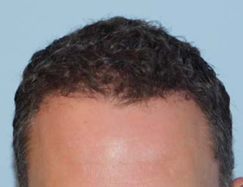 Hair Transplant (Smartgraft) Before & After Gallery - Patient 133066266 - Image 2