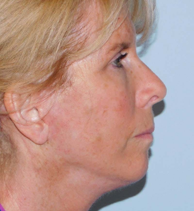 Mini-Facelift Before & After Gallery - Patient 133066271 - Image 4