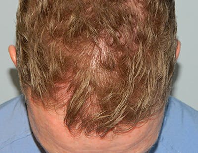 Hair Transplant (Smartgraft) Before & After Gallery - Patient 133066269 - Image 1