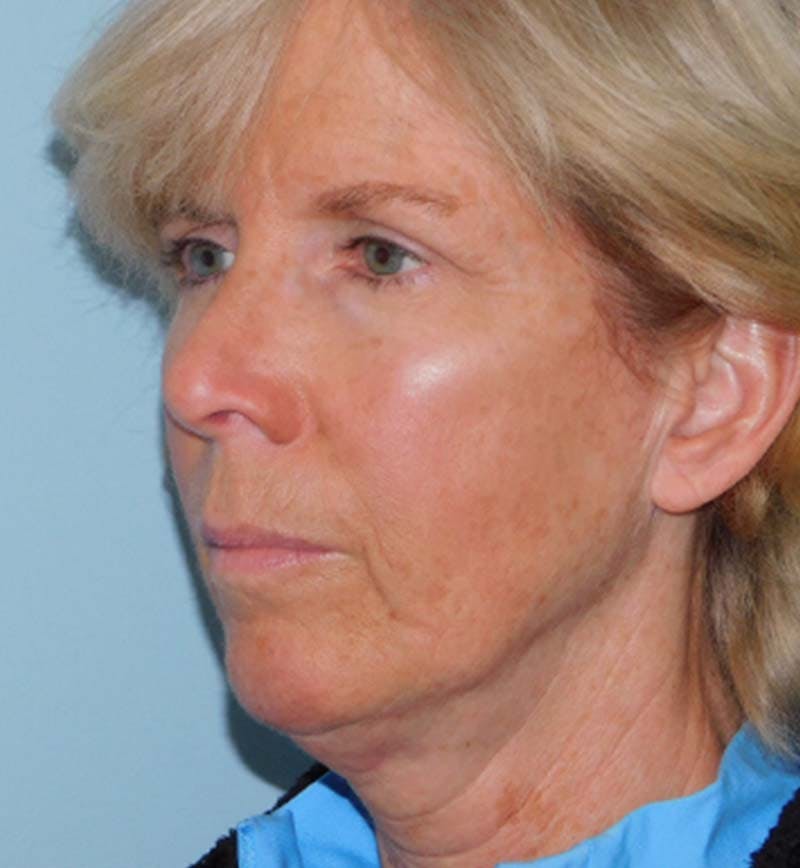 Mini-Facelift Before & After Gallery - Patient 133066271 - Image 5