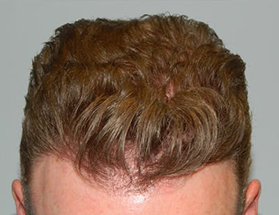 Hair Transplant (Smartgraft) Before & After Gallery - Patient 133066269 - Image 2