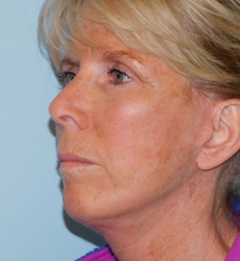 Mini-Facelift Before & After Gallery - Patient 133066271 - Image 6