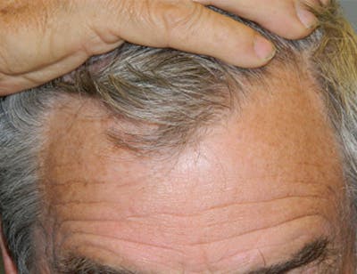 Hair Transplant (Smartgraft) Before & After Gallery - Patient 133066272 - Image 1