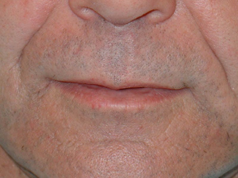 Lip Lift & Augmentation Before & After Gallery - Patient 133066274 - Image 1