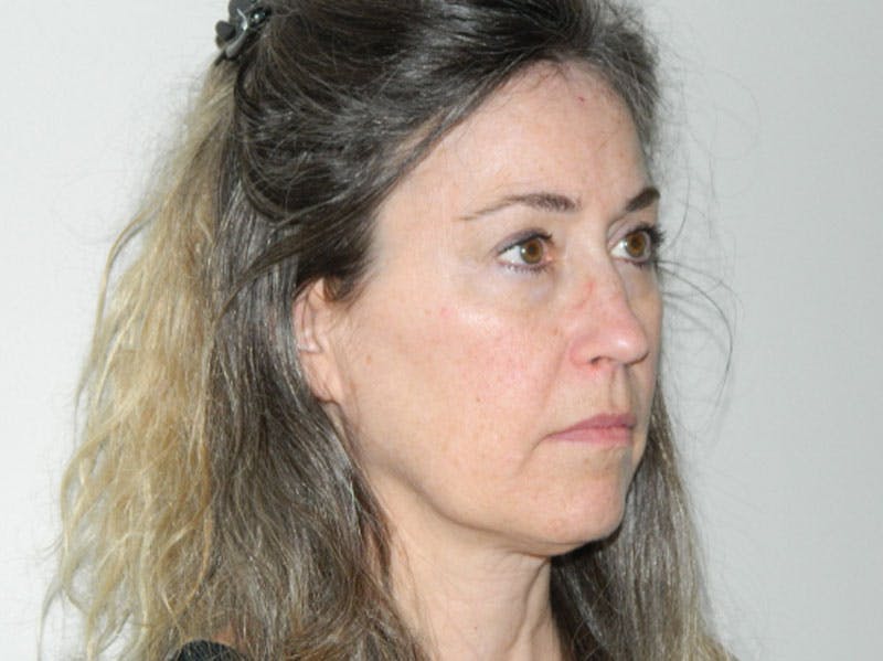 Mini-Facelift Before & After Gallery - Patient 133066285 - Image 1