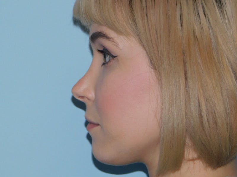 Before and After Nose Job in Main Line