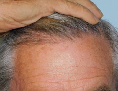 Hair Transplant (Smartgraft) Before & After Gallery - Patient 133066272 - Image 2