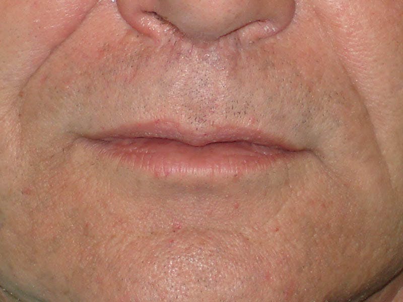 Lip Lift & Augmentation Before & After Gallery - Patient 133066274 - Image 2