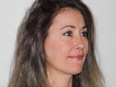 Mini-Facelift Before & After Gallery - Patient 133066285 - Image 2