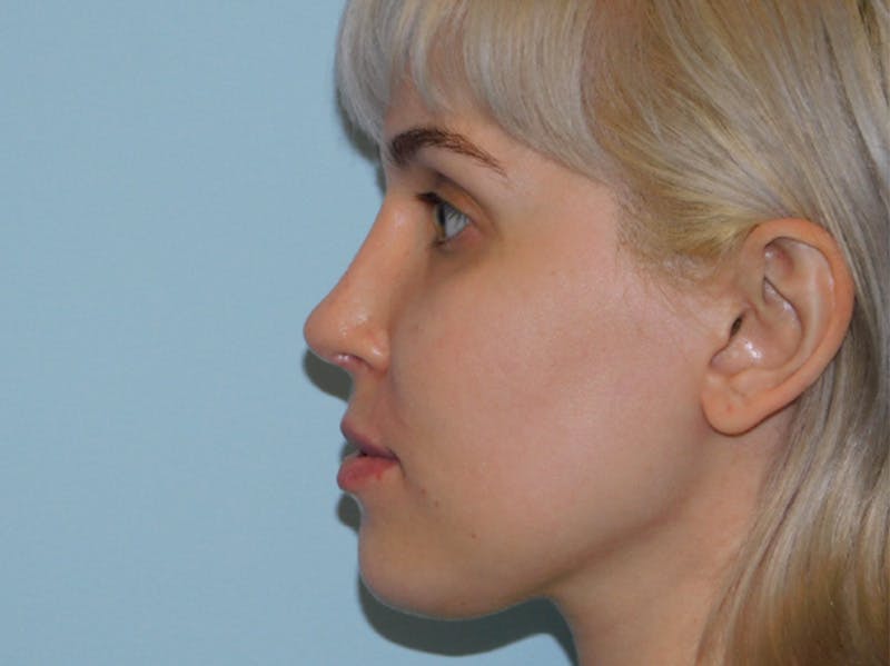 Before and After Nose Job in Main Line