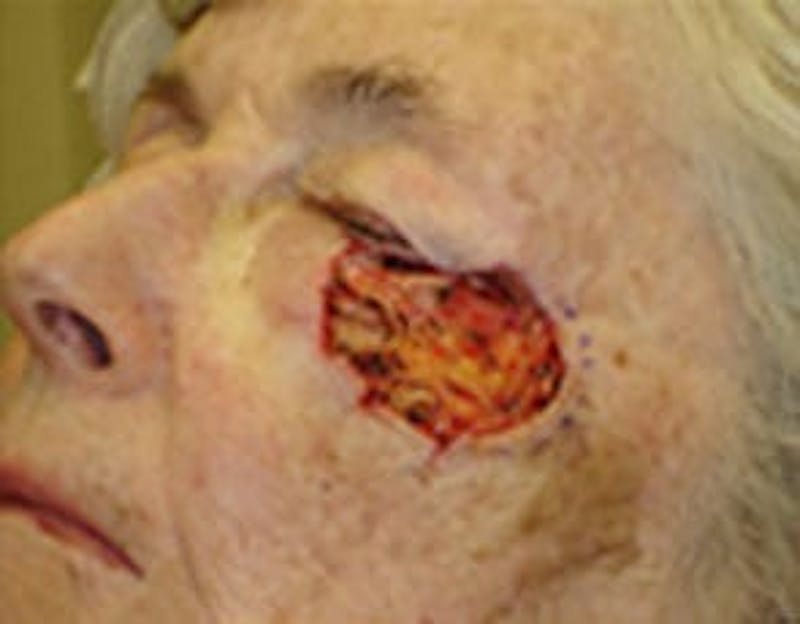 Reconstructive Surgery Before & After Gallery - Patient 133066278 - Image 1