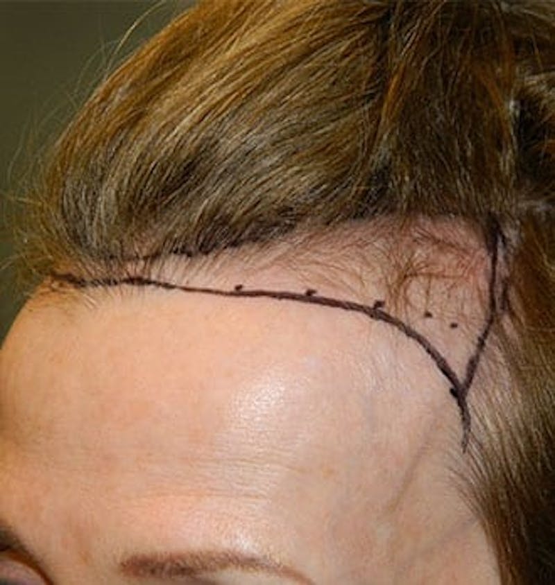 Hair Transplant (Smartgraft) Before & After Gallery - Patient 133066275 - Image 1