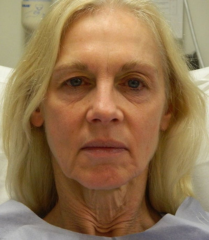 Brow Lift Before & After Gallery - Patient 133066280 - Image 1