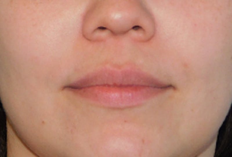 Lip Lift & Augmentation Before & After Gallery - Patient 133066276 - Image 1
