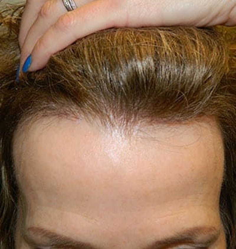 Hair Transplant (Smartgraft) Before & After Gallery - Patient 133066275 - Image 2