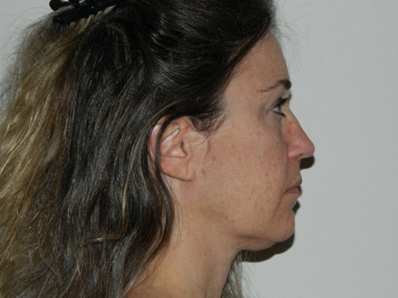 Mini-Facelift Before & After Gallery - Patient 133066285 - Image 3