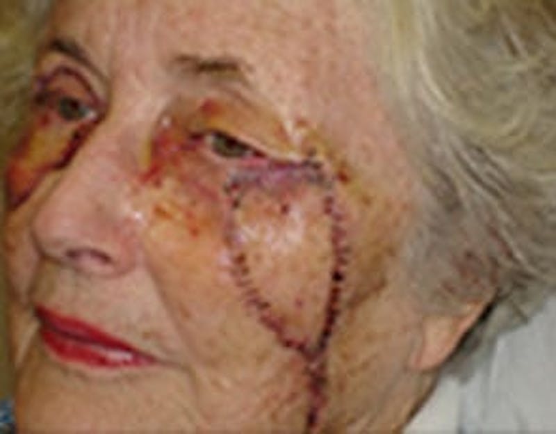 Reconstructive Surgery Before & After Gallery - Patient 133066278 - Image 3
