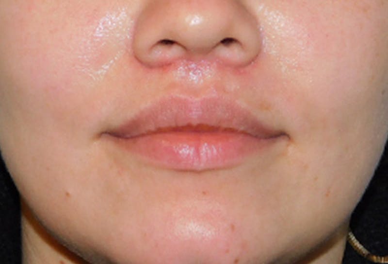 Lip Lift & Augmentation Before & After Gallery - Patient 133066276 - Image 2
