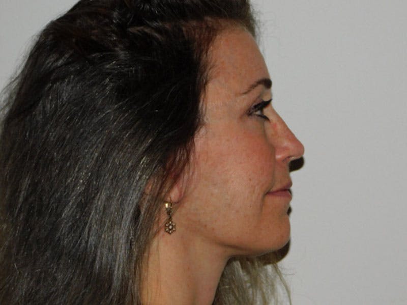 Mini-Facelift Before & After Gallery - Patient 133066285 - Image 4