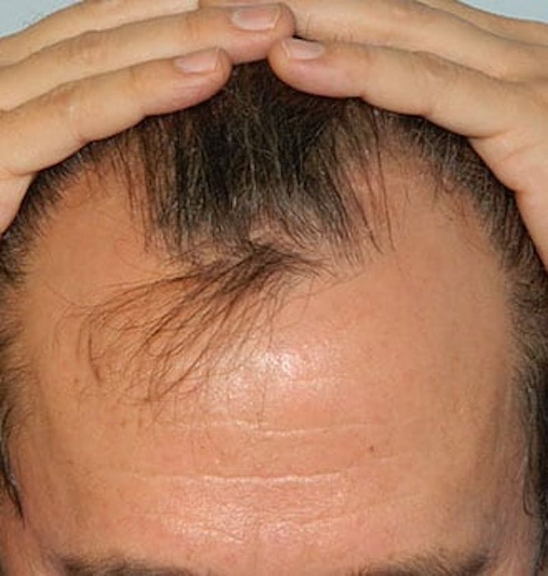 Hair Transplant (Smartgraft) Before & After Gallery - Patient 133066277 - Image 1