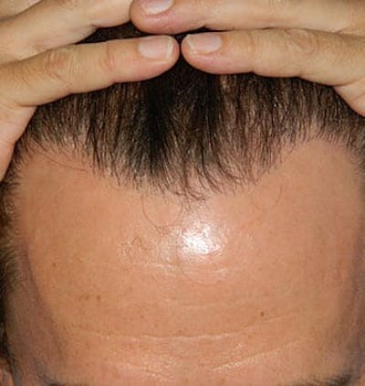 Hair Transplant (Smartgraft) Before & After Gallery - Patient 133066277 - Image 2