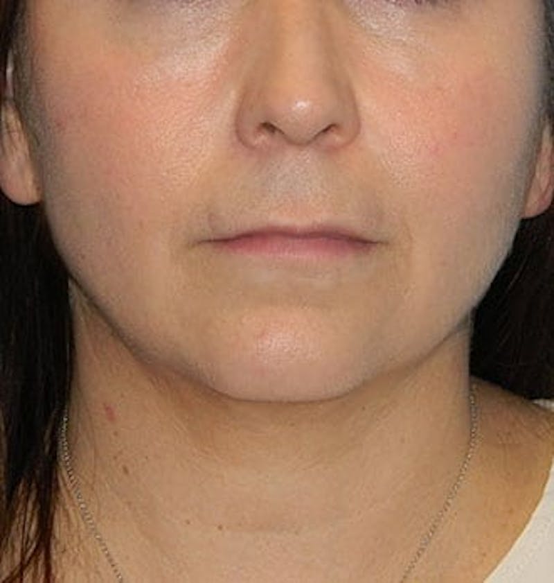 Lip Lift & Augmentation Before & After Gallery - Patient 133066283 - Image 1