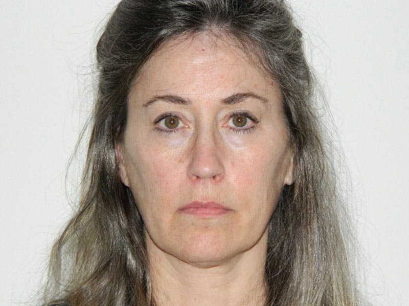 Mini-Facelift Before & After Gallery - Patient 133066285 - Image 5