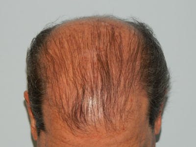 Hair Transplant (Smartgraft) Before & After Gallery - Patient 133066286 - Image 1