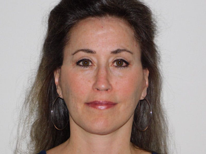 Mini-Facelift Before & After Gallery - Patient 133066285 - Image 6