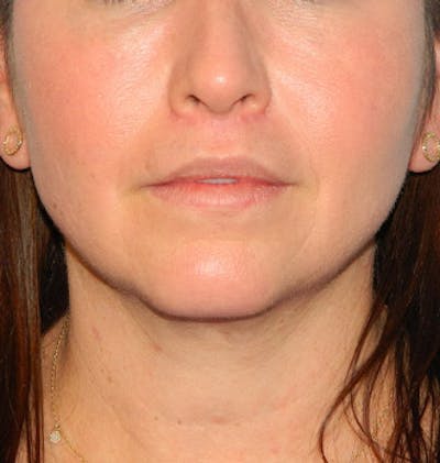 Lip Lift & Augmentation Before & After Gallery - Patient 133066283 - Image 2