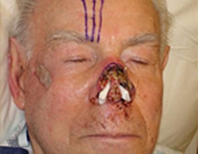 Reconstructive Surgery Before & After Gallery - Patient 133066288 - Image 1