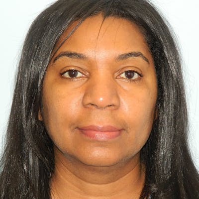 Lip Lift & Augmentation Before & After Gallery - Patient 133066291 - Image 1