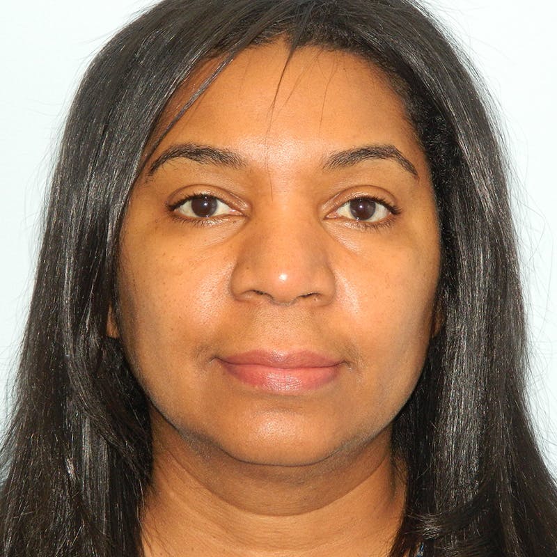Lip Lift & Augmentation Before & After Gallery - Patient 133066291 - Image 1