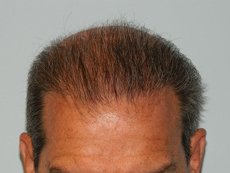 Hair Transplant (Smartgraft) Before & After Gallery - Patient 133066286 - Image 2