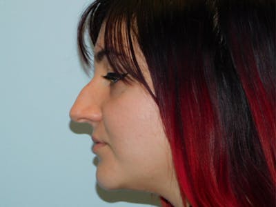Rhinoplasty Before & After Gallery - Patient 133066302 - Image 1