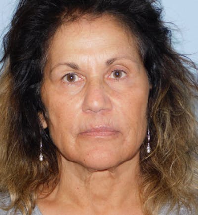 Mini-Facelift Before & After Gallery - Patient 133066296 - Image 1