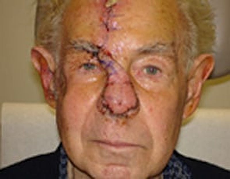 Reconstructive Surgery Before & After Gallery - Patient 133066288 - Image 3