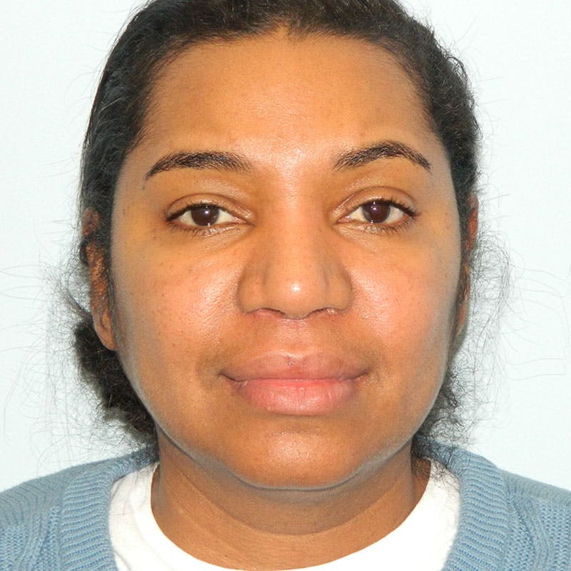Lip Lift & Augmentation Before & After Gallery - Patient 133066291 - Image 2
