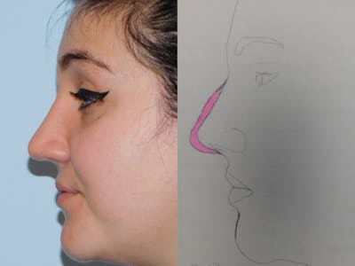Rhinoplasty Before & After Gallery - Patient 133066302 - Image 2