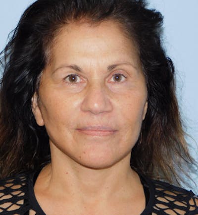 Mini-Facelift Before & After Gallery - Patient 133066296 - Image 2