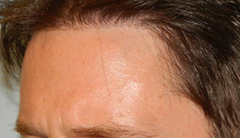 Hair Transplant (Smartgraft) Before & After Gallery - Patient 133066290 - Image 2