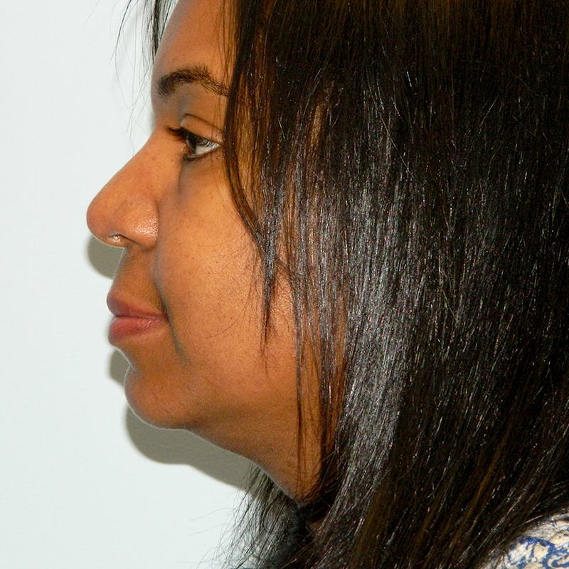 Lip Lift & Augmentation Before & After Gallery - Patient 133066291 - Image 3