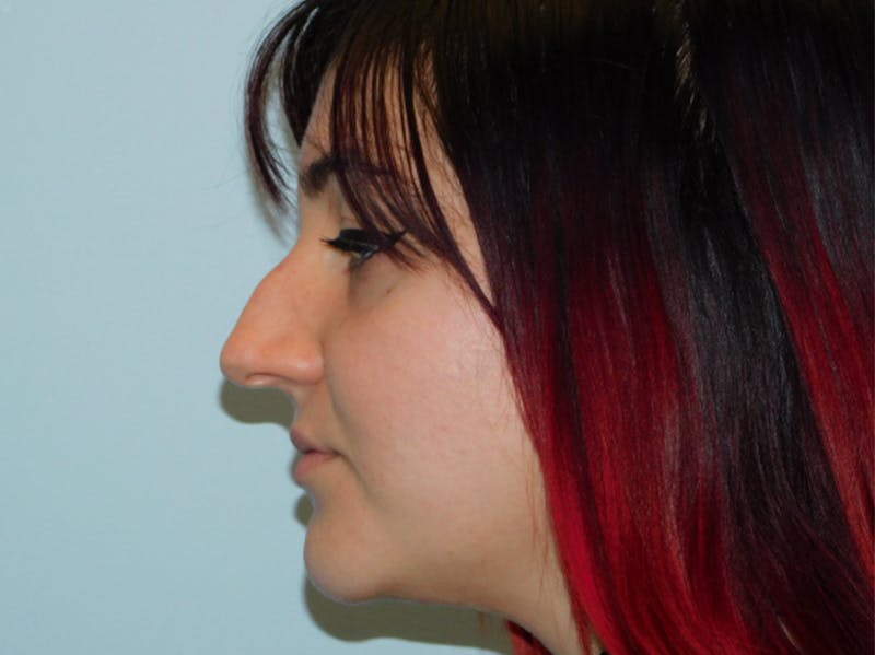 Before and After Nose Job in Philadelphia