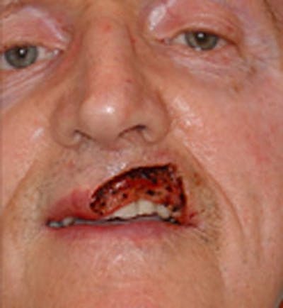 Reconstructive Surgery Before & After Gallery - Patient 133066289 - Image 1