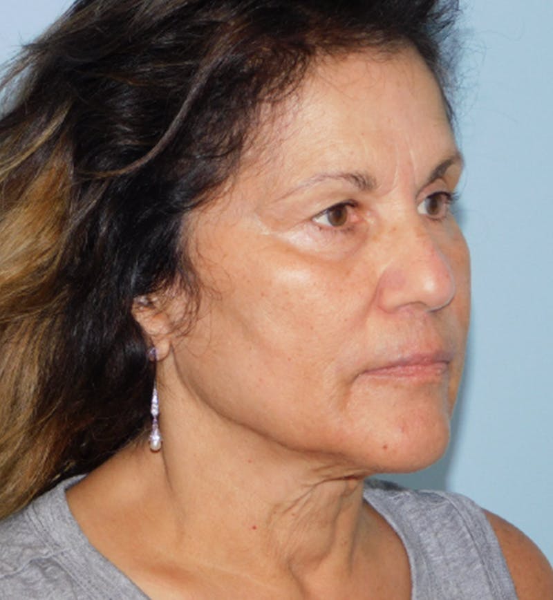 Mini-Facelift Before & After Gallery - Patient 133066296 - Image 3