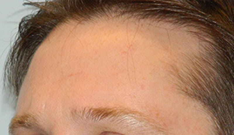 Hair Transplant (Smartgraft) Before & After Gallery - Patient 133066290 - Image 3
