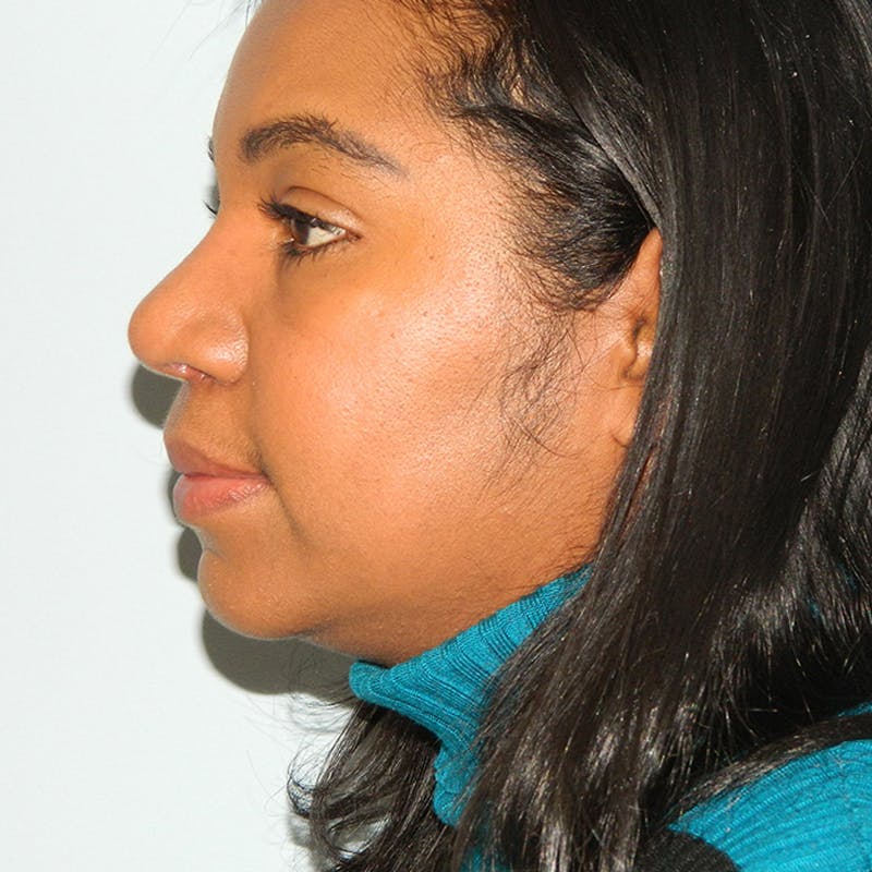 Lip Lift & Augmentation Before & After Gallery - Patient 133066291 - Image 4