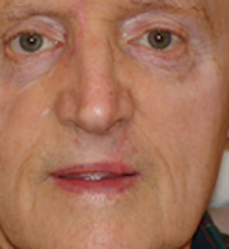 Reconstructive Surgery Before & After Gallery - Patient 133066289 - Image 2