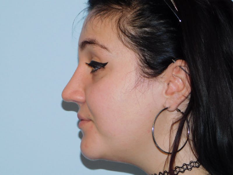Before and After Nose Job in Philadelphia