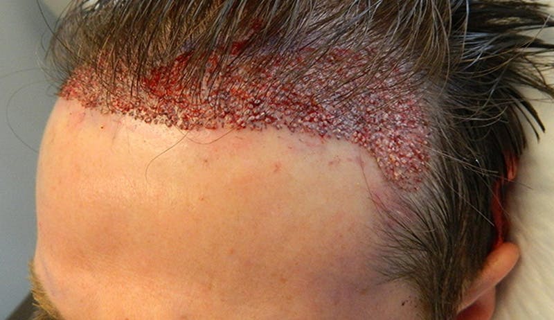 Hair Transplant (Smartgraft) Before & After Gallery - Patient 133066290 - Image 4